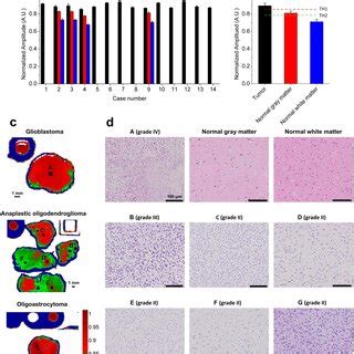 Discrimination Of Low And High Grade Of Human Gliomas With Tri A