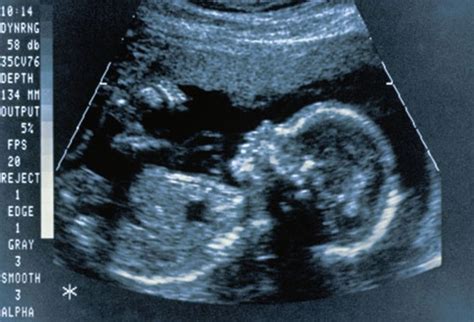 One Bump Herpes Pictures