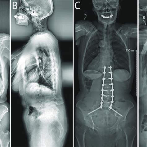 Preoperative Anteroposterior A And Lateral B Radiographs And