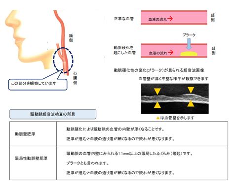 頸動脈超音波検診 公益財団法人宮崎県健康づくり協会