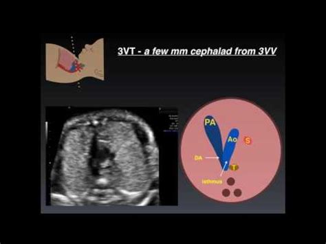 3 Vessel Umbilical Cord Means | 03 Cord Blood 2017