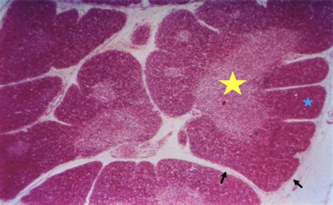 Lymphoid pathology Flashcards | Quizlet