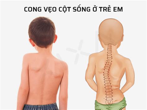 Vẹo Cột Sống ở Trẻ Nguyên Nhân Biểu Hiện Và Các Biện Pháp Phòng Ngừa