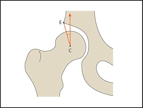 Anterior Center Edge Angle
