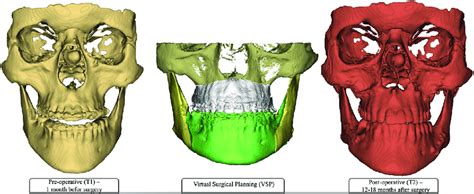 Three Dimensional Reconstruction Of T1 CBCT VSP And T2 CBCT The