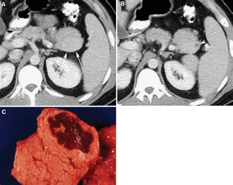 Intrapancreatic Accessory Spleen Ct Appearance And Differential Diagnosis Semantic Scholar