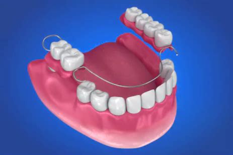 Próteses Dentárias O Doutor Responde