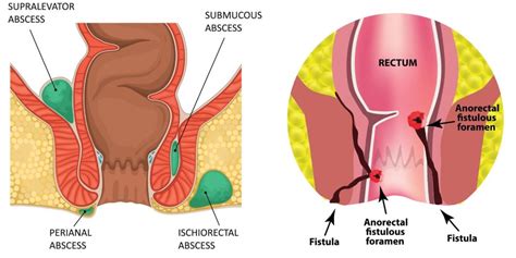 Anal Fistula Vs Anal Abscess How To Tell The Difference