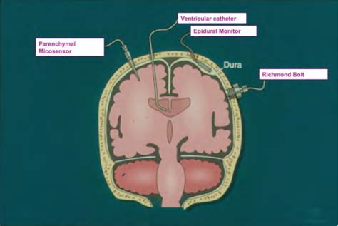Figure 1 From Management Of Increased Intracranial Pressure Semantic