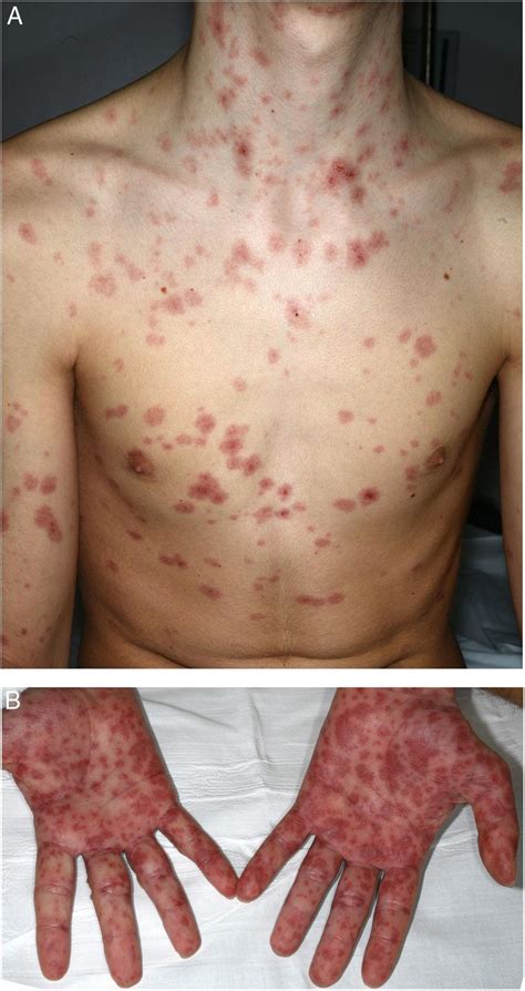 Steven Johnson Syndrome Lamictal