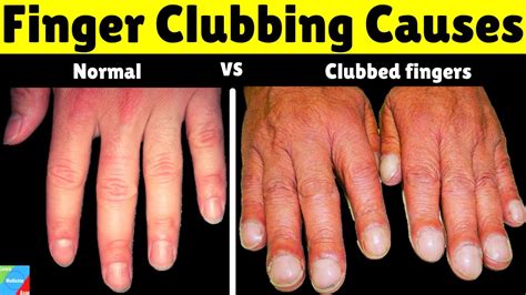 Finger Clubbing Finger Nail Clubbing Causes Grades Of Finger