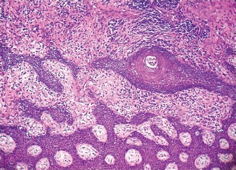 Histopathological Photograph Showing Granulomas H And E Stain 20