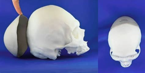 3D Systems Receives FDA Clearance For 3D Printed VSP PEEK Cranial