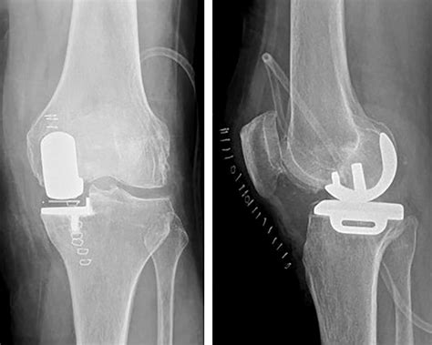 Unicompartmental Knee Replacement Current Perspectives Journal Of