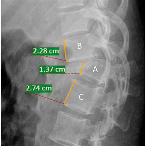 Measurement Of The Kyphotic Angle Angle Of Kyphotic Deformity Of The