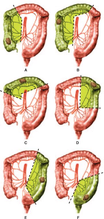 Chapter Short Answer Colon Resections Pp Diagram Quizlet