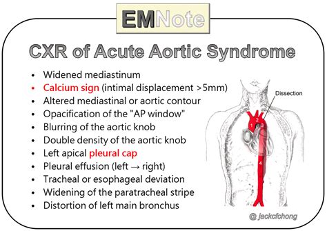 Aortic Dissection Symptoms And Causes Mayo Clinic Aor