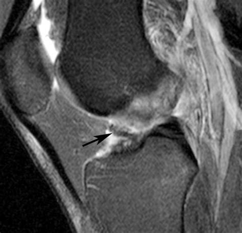 a. Posttrauma cyclops lesion in a 27-year-old woman with a high-grade ...