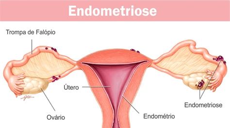 Como É A Dor Da Endometriose - Endometriose: causas, sintomas, diagnóstico, tratamento e recuperação