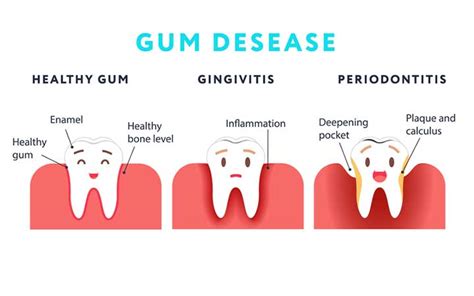 Gingivitis Can Be Cured At Home In Its Early Stages University Health