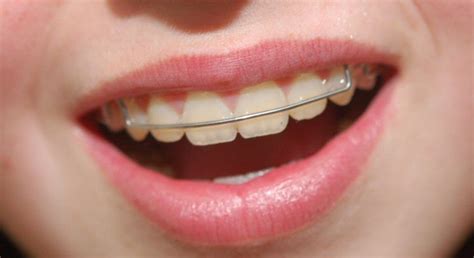 Invisalign Retainers Top Orthodontist Braces Invisalign