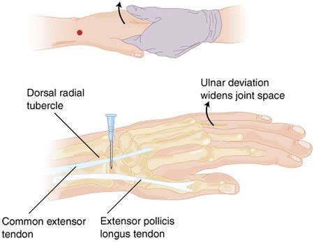 Arthrocentesis: wrist - WikEM