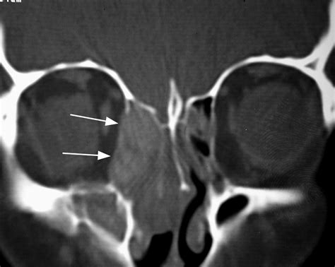 Imaging Features Of Invasive And Noninvasive Fungal Sinusitis A Review