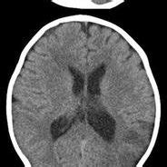 Initial Brain CT Images Taken 12 H After The Onset Of Stroke Axial