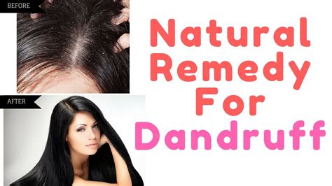 Miracle Natural And Home Remedy For Dandruff Hair Regrowth Top