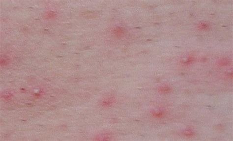 Sebaceous Cyst In Groin Area Male at Walter Mcglothlin blog
