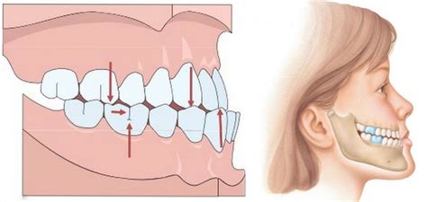 ﻿Виды прикуса | Стоматология «Проприкус»