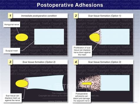 Postoperative Adhesions Trialquest Inc