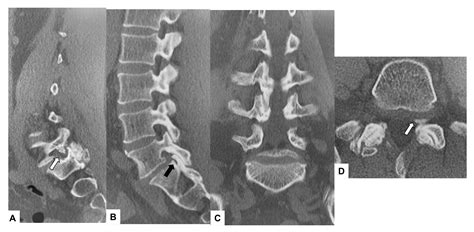 Transtubular Endoscopic Posterolateral Decompression For L5 S1 Lumbar