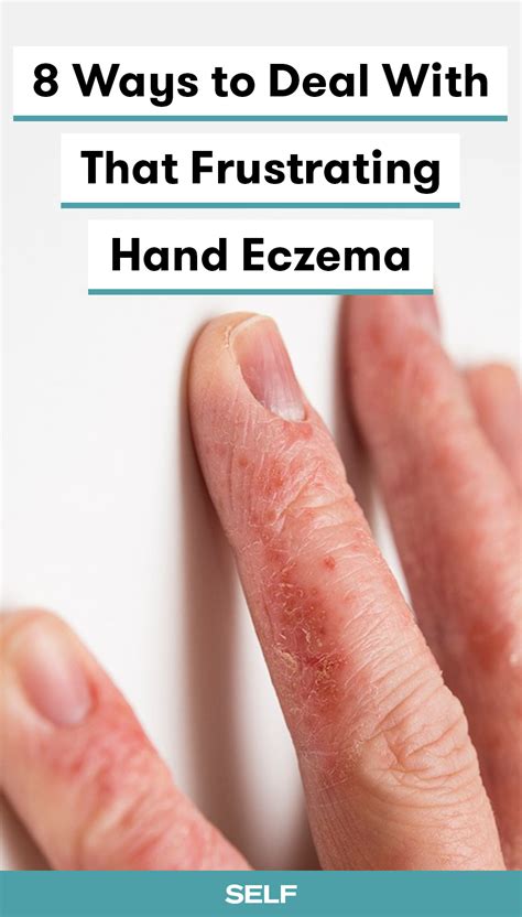 How To Finally Get Relief For Your Hand Eczema Artofit