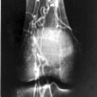 Fig L Femoral Arteriogram Showing Occlusion Of The Middle Third Of