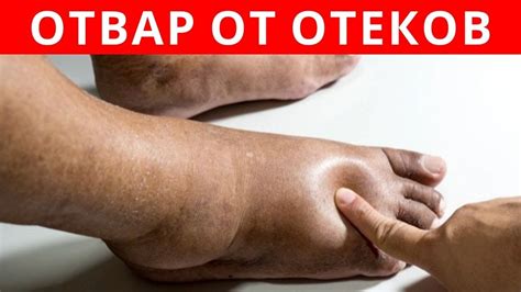 МОЩНЫЙ ОТВАР от ОТЕКОВ - YouTube