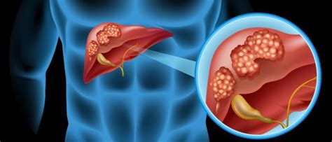 Liver Cancer Liver Cancer Johns Hopkins Pathology