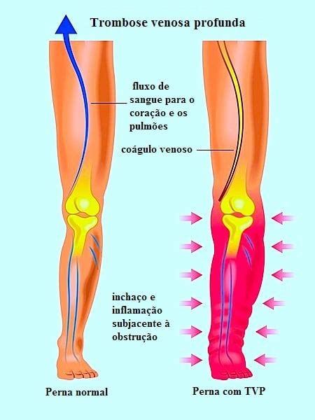 Dor Na Perna Direita Ou Esquerda Causas E Tratamento