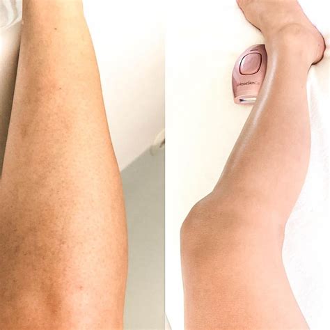 Brazilian Laser Hair Removal Before And After Photos