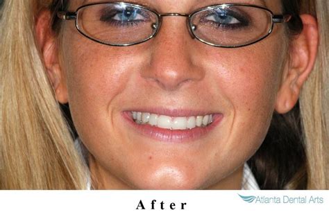 Lumineers Before And Afters Myles Williams Dds Atlanta Dental