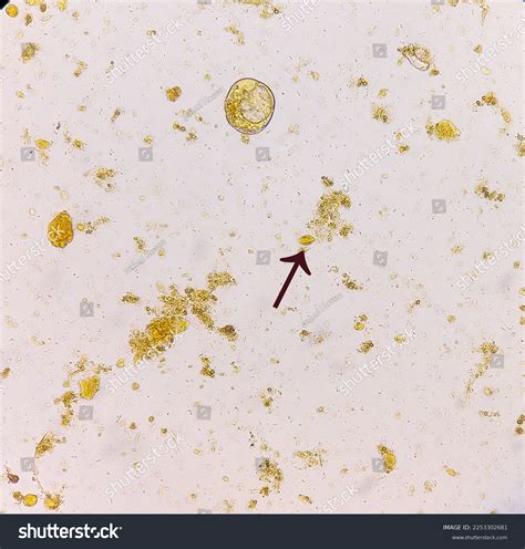 Blastocystis Hominis Cyst