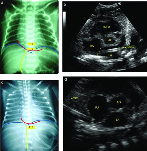 Umbilical Venous Vs Arterial Catheter