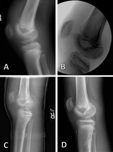 Imaging showing improvement of displacement of tibial spine fracture ...