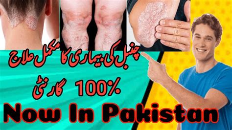 Psoriasis Chambal Treatment Now Available In Pakistan With