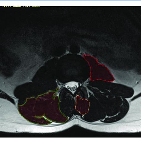 Demonstration Of The Cross Sectional Area Measurement Of The Lumbar