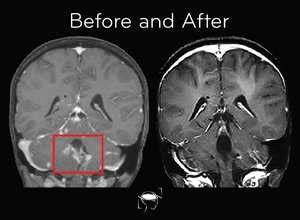 Brain Tumor Types Glioblastoma Meningioma More