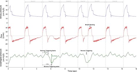 Asincronías Paciente Ventilador Tecne y Medeos