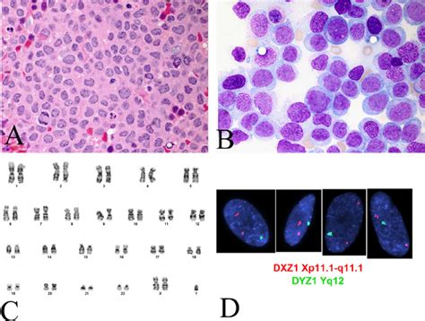 A Bone Marrow Clot Section Shows Sheets Of Large Blasts With