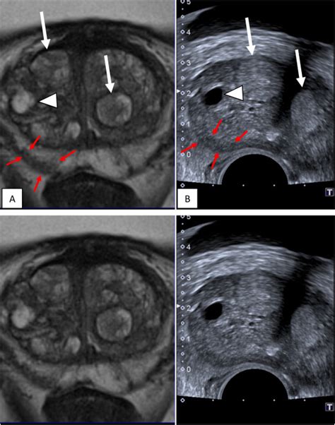 Multiparametric Magnetic Resonance Imaging For The Detection Of