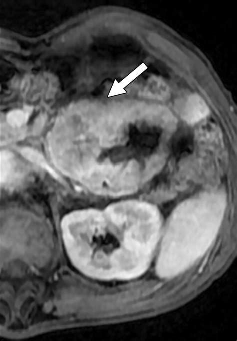 MRI Features Of Gastrointestinal Stromal Tumors AJR